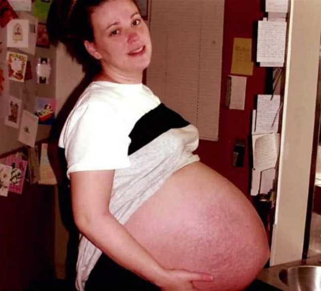 Удивительные случаи многоплодных беременностей