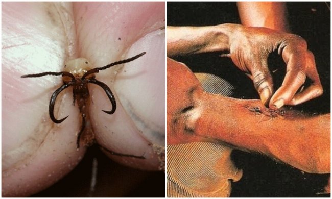 Как муравьёв используют в качестве хирургического шва
